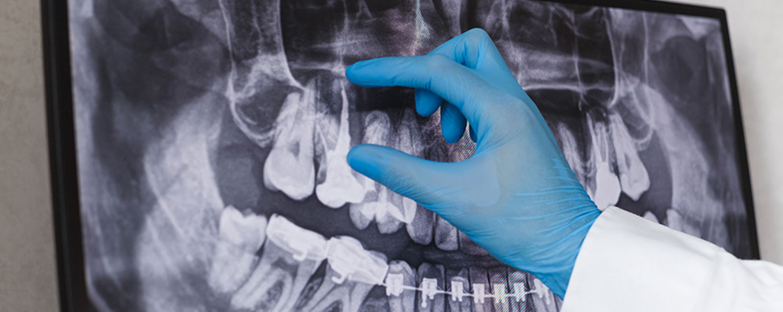 Endodontologie (Wurzelkanalbehandlung)